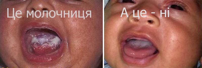Молочниця (кандидоз) при ГВ