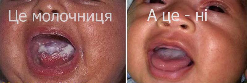Молочниця (кандидоз) при ГВ